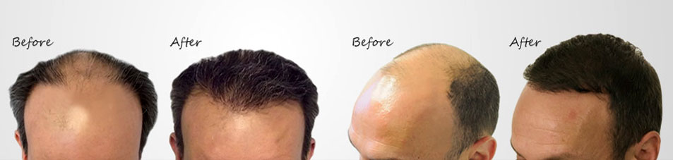 hair-transplantation